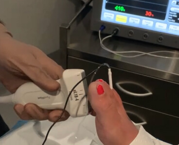 Rf Ablation Of Mortons Neuroma